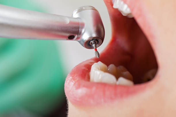 Best Emergency Dental Extractions in Rolling Meadows, IL